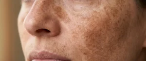 Melasma tem cura? Dermatologista Einstein
